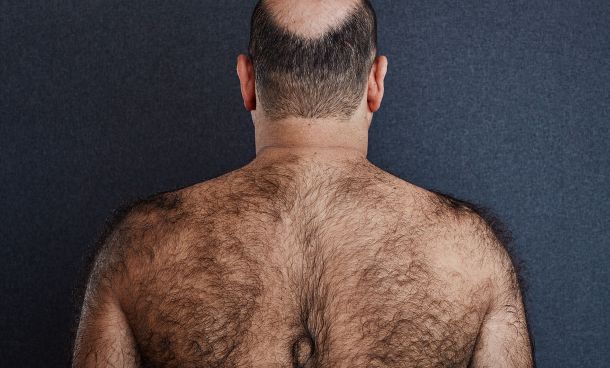 Haarentfernung mit Laser Rücken Blankenese